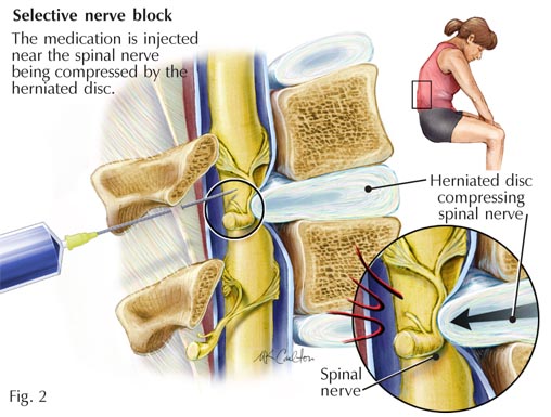 nerve-root-block nerve-root-block